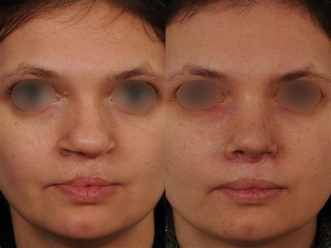 Rhinoplastie avant après photos et exemples de nez refaits