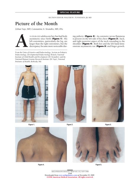 PDF Picture Of The Month Klippel Trenaunay Syndrome