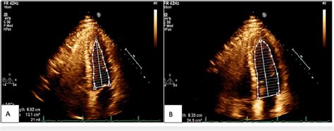 Apical Four Chamber View Of Second Follow Up Echocardiogram After