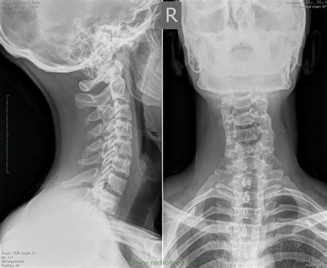 Шейный отдел позвоночника | Портал радиологов