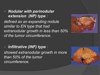 Hepatocellular Carcinoma Pptx