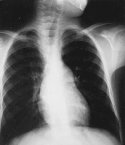 Pulmonary Stenosis Musculoskeletal Key