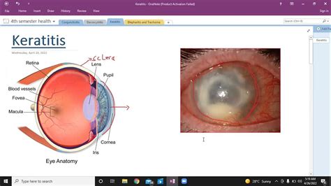 Keratitis Types Of Keratitis Ophthalmology Usmle Step 1 Youtube