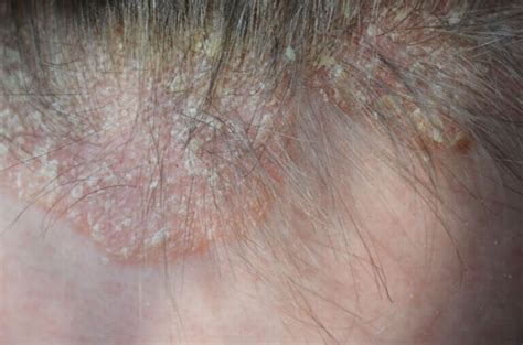 Psoriasis En El Cuero Cabelludo Síntomas Y Tratamiento — Mejor Con Salud