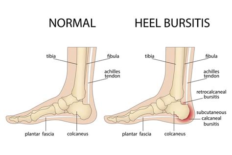 Haglund Deformity Surgery: Effective Treatment for Heel Pain