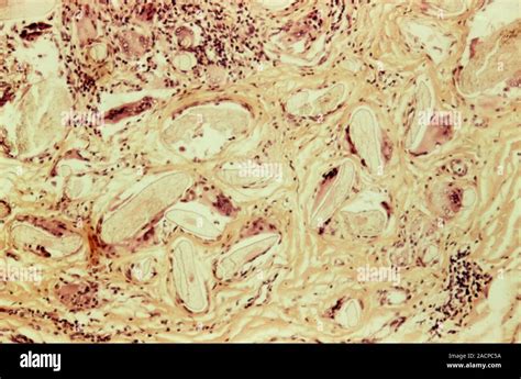 Dermoid Ovarian Cyst Light Micrograph Of A Section Through An Ovary