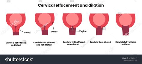 Cervical Effacement Dilation During Childbirth 1 Stock Illustration