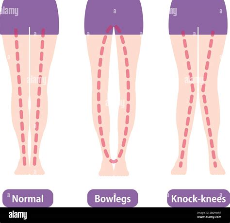 Diferencias Entre Los Tipos De Ngulos De Piernas Y Las Rodillas