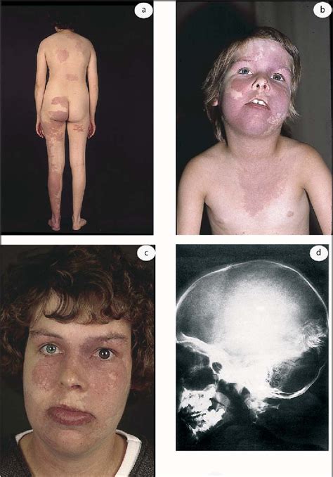 PDF Klippel Trenaunay Syndrome And Sturge Weber Syndrome Variations