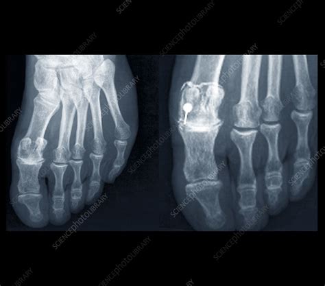 Osteoarthritis of the foot, X-ray - Stock Image - C026/9894 - Science ...