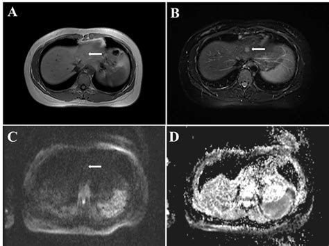 Frontiers Case Report Primary Lymphoepithelioma Like Intrahepatic