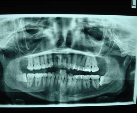 Keratocystic Odontogenic Tumor In The Maxillary Sinus A Case Report