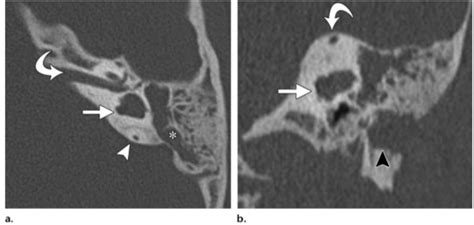 Malformations Of The Vestibule And Semicircular Canals A Axial Ct Download Scientific