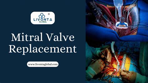 Mitral Valve Replacement - Livonta Global Pvt Ltd