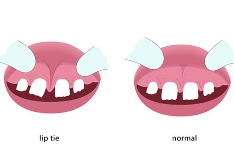 Labial Frenectomy Before And After