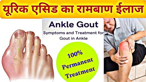 यूरिक एसिड का रामबाण इलाज Gout Treatment Medicine Uric Acid Tablet Allopurinol Youtube