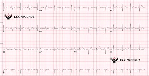 Literature Review: ST segment elevation, but not in contiguous leads! – ECG Weekly