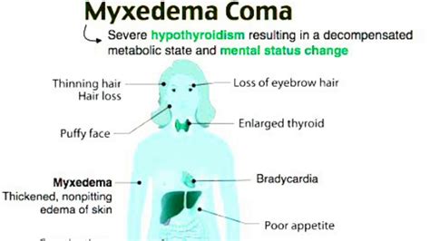 Myxedema coma/hypothyroidism - YouTube