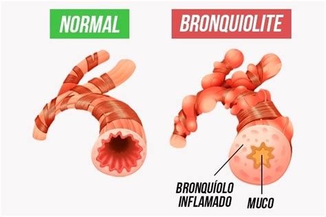 Bronquiolite O Que Sintomas Causas E Tratamento Tua Sa De