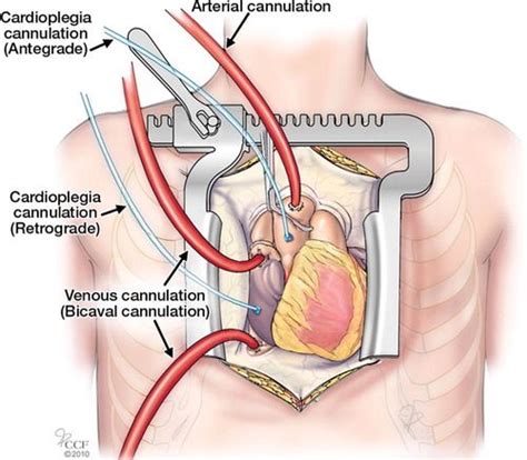 Basics Of Cardiopulmonary Bypass Normal And Abnormal Postoperative Ct Appearances