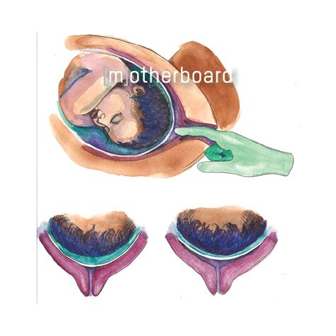 Membrane Sweep — Motherboard Birth