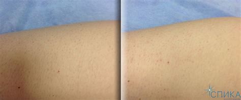 Лазерная эпиляция волос в Санкт-Петербурге | Цена эпиляции лазером ...