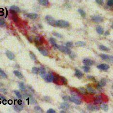 Illustration Of A SMA Immunostaining Scoring A SMA Positive Cells Were