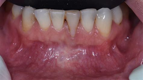 Cirugía plástica periodontal Injerto Gingival Libre o Tunelización con