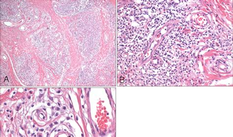 Histopathologic Examination Demonstrates A Multiple Lobular