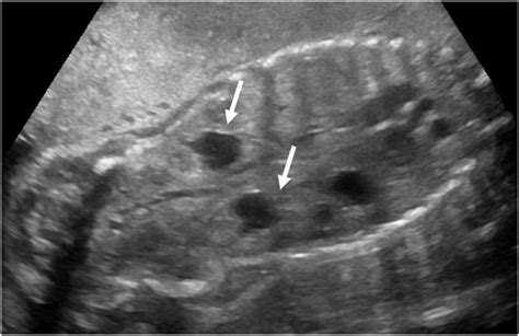 Renal Pelvic Dilation American Journal Of Obstetrics And Gynecology