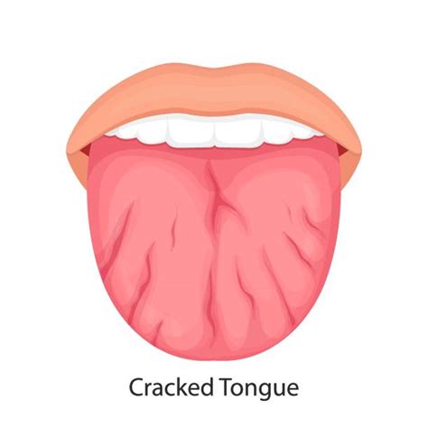 Dry Cracked Lips stock vectors - iStock