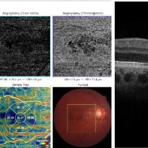 Oct And Octa Imaging At The St Year After Trauma To The Right Eye