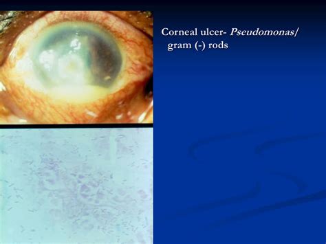 Ppt Infectious Keratitis Differential Diagnosis And Clinical