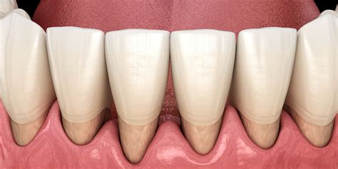 Receding Gums Eastern Dental