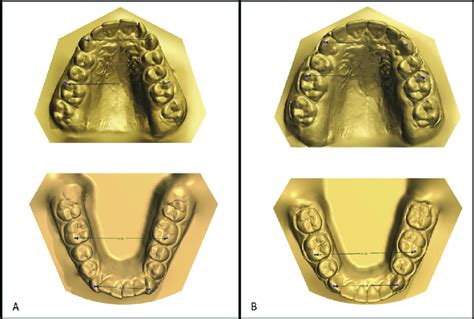 Maxillary And Mandibular Intercanine And Intermolar Width Measurements