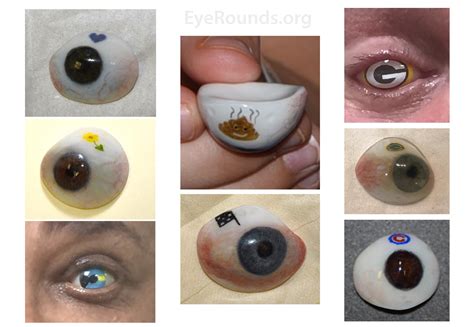 Prosthetic Eyeball