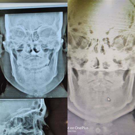 Case Of Mandible Symphysis Fracture due to Road Traffic Accident | Dr ...