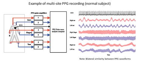 Photoplethysmography (PPG): State-of-the-art methods and applications ...