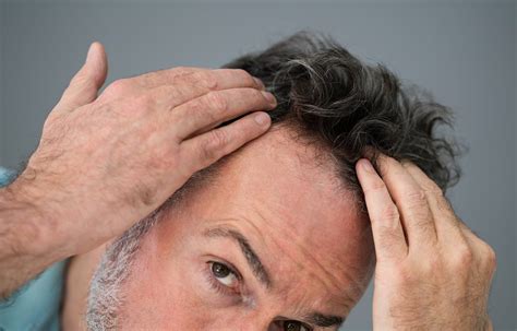 Male Pattern Baldness Causes And Solutions Eldorado