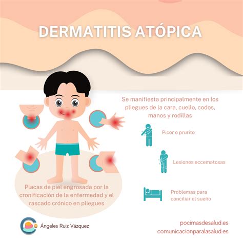 Ce Este Dermatita Atopica Hot Sex Picture