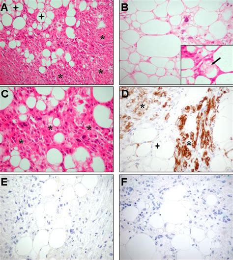 Pathohistologic investigation of the retroperitoneal sarcoma Histology ...