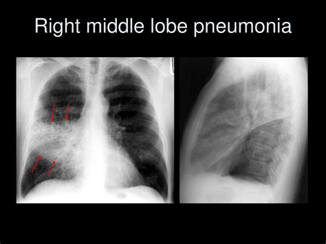 Ppt The Complete Idiot’s Guide To Reading The X Ray Powerpoint Presentation Id 583063