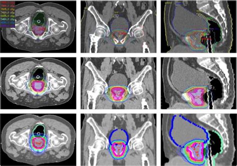 Radiation Therapy Techniques for Treatment of the Prostate - Karen ...