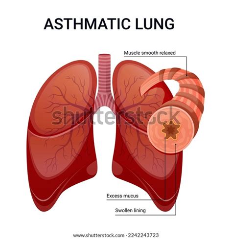 Asthma Lung Vector Diagram Illustration Stock Vector (Royalty Free) 2242243723 | Shutterstock