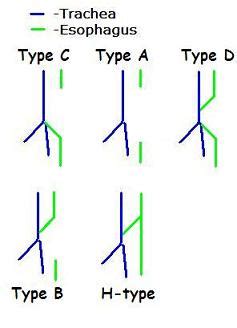 Tracheoesophageal fistula - wikidoc