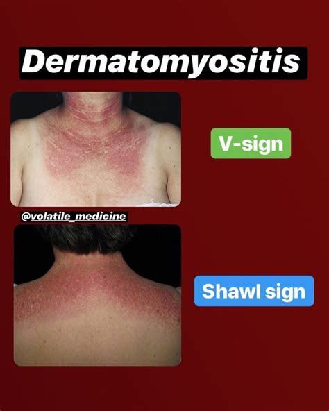 Volatile Medicine🌡🦠🧬 on Instagram: “Dermatomyositis (DM) is a long-term ...