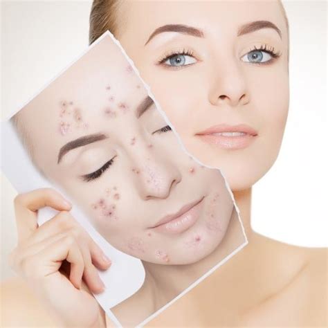 Acne Scars Treatment Removal In Chicago Il Bella Sana Med Spa