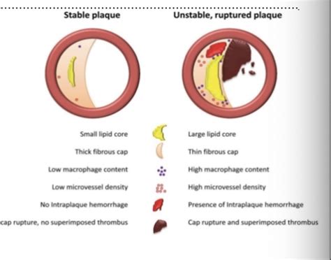 Chest Pain And Acute Coronary Syndrome Flashcards Quizlet