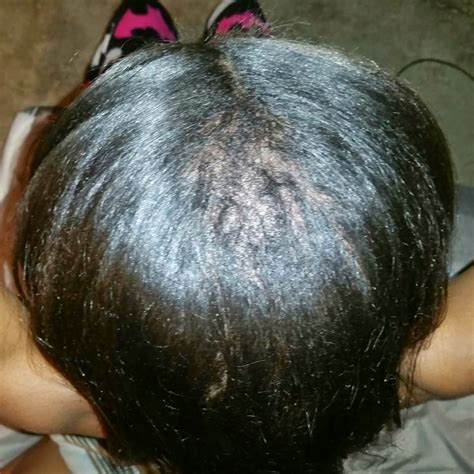 How I Made A Come Back The Right Way And Reversed My Severe Crown Breakage