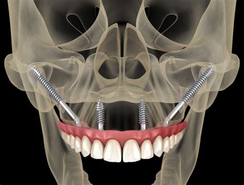 Zygomatic Implants In India Teeth Care Centre Dental Hospital